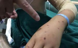 回家途中遭胡蜂襲擊，湖北女子冒死護(hù)兒引開蜂群被蟄230口