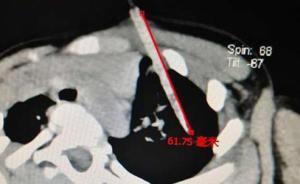 边吃鸡肉串边奔跑不小心摔倒在地，2岁女童肺部被竹签扎穿