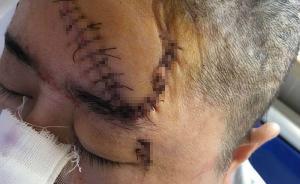 安徽蕪湖一女子勸架時被對方丈夫砍傷，全身縫了106針