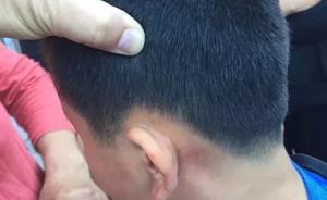 12歲男生被打成腦震蕩，媒體：“脫管”的托管機(jī)構(gòu)亟須規(guī)范