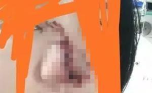 杭州姑娘酒后逗犬被咬面部縫30多針：涉事犬無證，城管立案