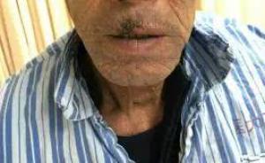 大連老漢長期暴曬患上鱗癌，此類患者中漁民不少