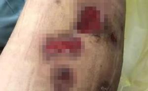 杭州女子打瘦腿針后皮膚潰爛險(xiǎn)截肢，排查數(shù)月找出神秘細(xì)菌