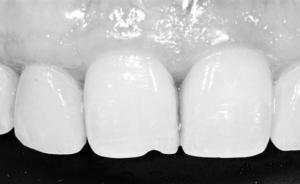 瓜子一次能嗑一斤，35歲女子門牙嗑出1毫米深V形缺口