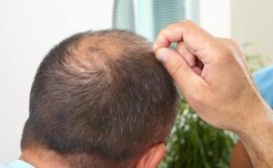 华西医院招30人测试防脱育发液产品，一天8000人来报名