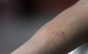 明知被眼鏡蛇咬傷，習(xí)武男子自行處理傷口還喝酒當(dāng)晚毒發(fā)