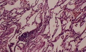 美國科學(xué)家確認(rèn)癌細(xì)胞可“遠(yuǎn)程繳械”免疫系統(tǒng)