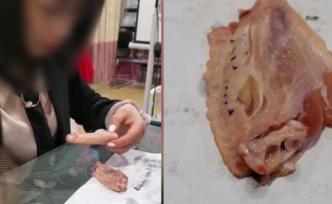 用雞翅練習(xí)割雙眼皮，兩天速成美容師？