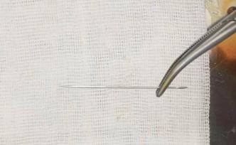 杭州女子腿疼难忍半个多月，体内竟藏着一根不断游走的缝衣针