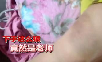 怀孕教师将11岁女童打到淤紫，校方：其有产前焦虑，已辞退