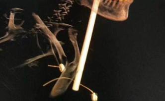 天降钢管插穿保洁工头部：尚未脱离生命危险，警方展开调查