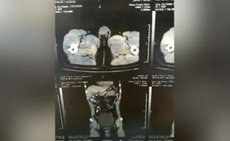 男子吞63根“毒香腸”販毒，分8天排出