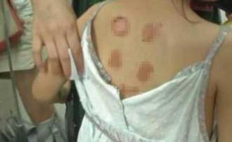 国家中医药管理局组织专家赴江西指导“三伏贴”不良反应诊治