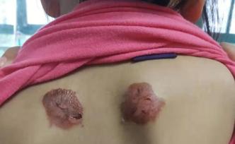 江西被三伏贴灼伤儿童最小仅11个月，专家：含强刺激性物质