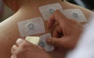 三伏天貼三伏貼藥到病除？不！那只是心理作用