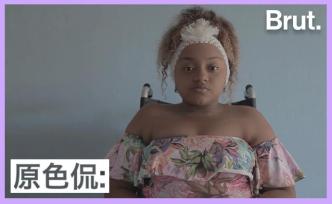 哥倫比亞“玻璃人”：哪怕骨折18次，我也有個舞蹈夢