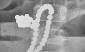 又是磁力珠：5歲男孩吞下46顆，胃腸十處穿孔住進(jìn)ICU