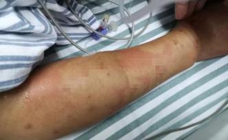 打山核桃捅到巨型马蜂窝，杭州夫妻被蜇近百口未脱离生命危险