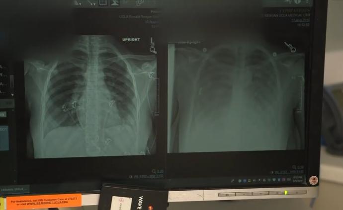 美國電子煙致病數(shù)據(jù)：1299病例26死