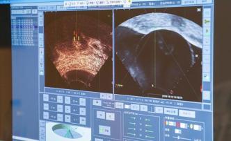 新時代新作為新篇章｜手握鼠標，上海醫生“隔空燒掉”病灶