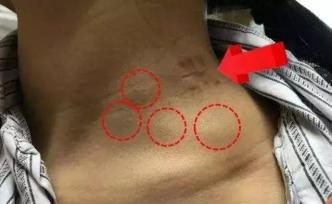 淋巴結(jié)腫大是因為毒素排不出去？如何快速排毒消腫？