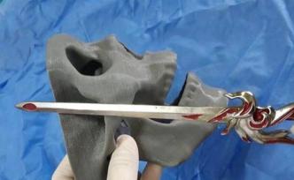 佛山11歲男童臉頰被玩具鐵劍刺入，險(xiǎn)刺破顱內(nèi)大動(dòng)脈