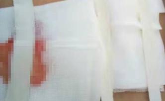 兩百名患者因針灸皮膚潰爛？河南杞縣：人數(shù)沒(méi)那么多，正調(diào)查