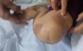 杞縣回應(yīng)多人針灸后皮膚潰爛：消毒不規(guī)范致膿腫分枝桿菌感染