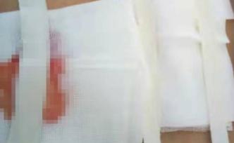 杞縣115人針灸后皮膚潰爛：或醫(yī)源感染，警方詢問涉事村醫(yī)