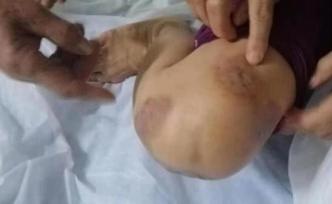 杞縣百余人針灸后皮膚潰爛：為何會(huì)染膿腫分枝桿菌，如何治療