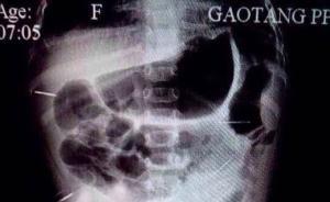 山东11个月女婴全身被深插16根钢针，警方已立案