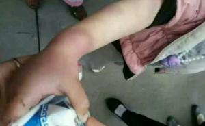 河北7歲女孩被虐滿身青紫，自稱爸爸打的警方已經(jīng)介入