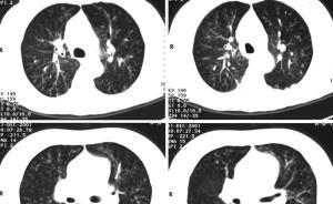 苏大：一学生瞒报肺结核，疾控排查后确诊5病例、十余疑似