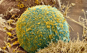 艾滋病毒被癌癥治療手術(shù)意外“清零”，但專家稱不能停藥