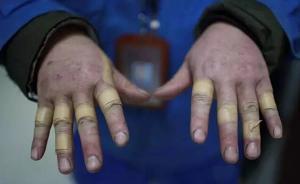 貼滿創(chuàng)可貼的雙手主人找到了：上海一工人，3天搶修千只水表