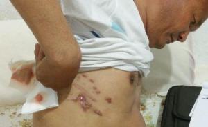 患者“右腎丟失”事件劇情幾度反轉(zhuǎn)，“腎去哪了”仍是謎