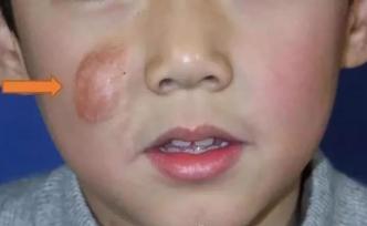 寶寶血管瘤長(zhǎng)得太厚外用藥無(wú)效，注射治療會(huì)不會(huì)有風(fēng)險(xiǎn)？