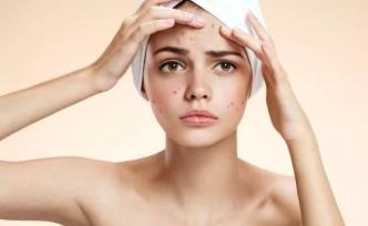 針清、擠壓、硬排，美容院的“暴力祛痘”究竟是否有效？