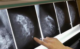 乳腺問答：越全越貴的乳腺檢查就越好嗎？
