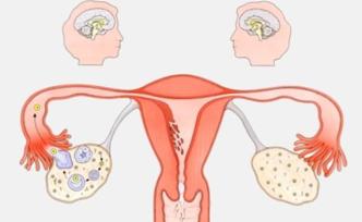 多囊卵巢綜合征之 “指揮官”與“泡”兵決戰(zhàn)