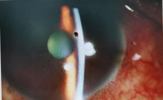 容易被忽視的角膜異物