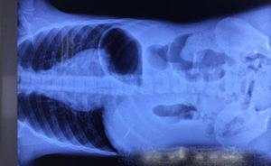 蘇州一7歲男孩體內(nèi)藏針長達(dá)六年，緊貼肝臟如“定時(shí)炸彈”