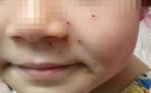 河南一女童培訓(xùn)班上答不出題，被老師用鉛筆在臉上扎了6個洞