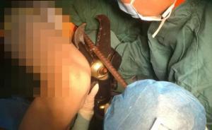 深圳一工人摔倒被鋼筋貫穿身體，醫(yī)院請6名消防官兵協(xié)助手術(shù)
