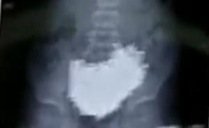 视频｜江西初三学生长期遭同学欺凌，吞1.4斤铁钉欲自杀