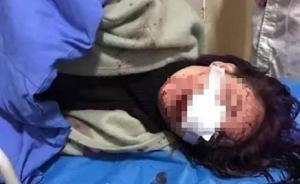 丽江被打毁容女子鉴定为轻伤二级，已达刑事量刑标准