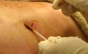 理發(fā)店做“放血排毒”，顧客疼到報警