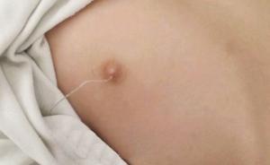 缝衣针没入浙江东阳19个月幼儿乳头、扎进肝脏，家属已报警