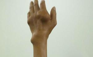 四川一男子饮酒多年双肘长出拳头大小痛风石，生活不能自理