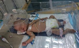 無錫三個月大男嬰疑遭虐待：5根肋骨骨折，還有燙傷和咬傷